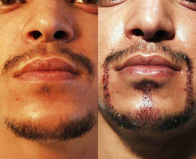 Beard & Mustache Transplantation Results