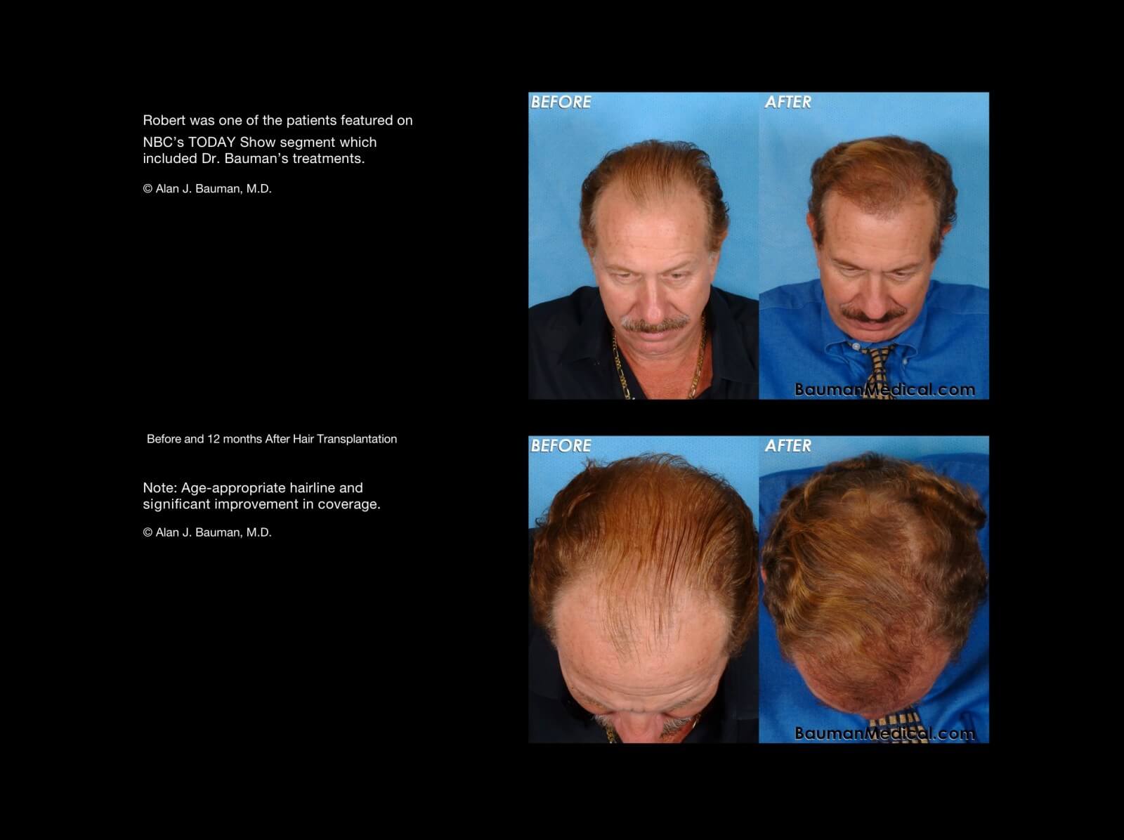 DrAlanBauman male hair transplant results before after_14 1600x1196