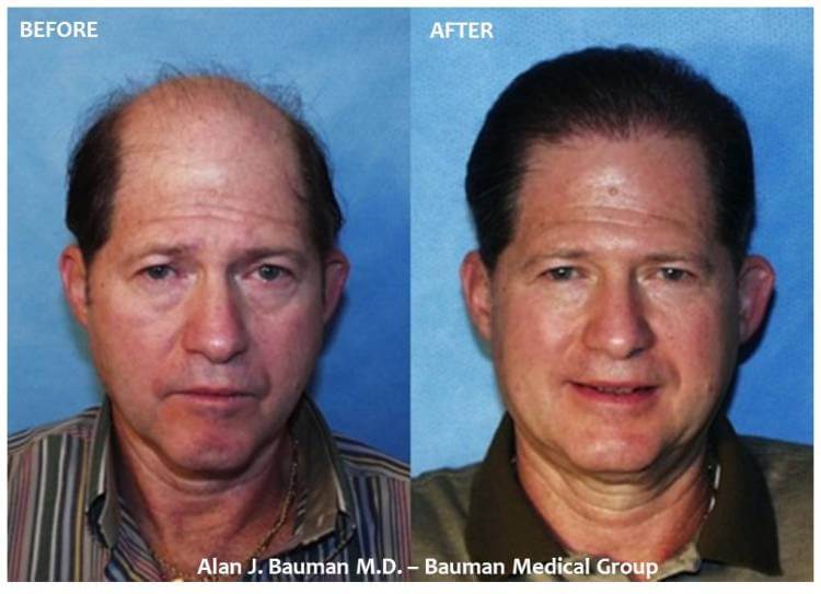 Male Hair Transplant Results