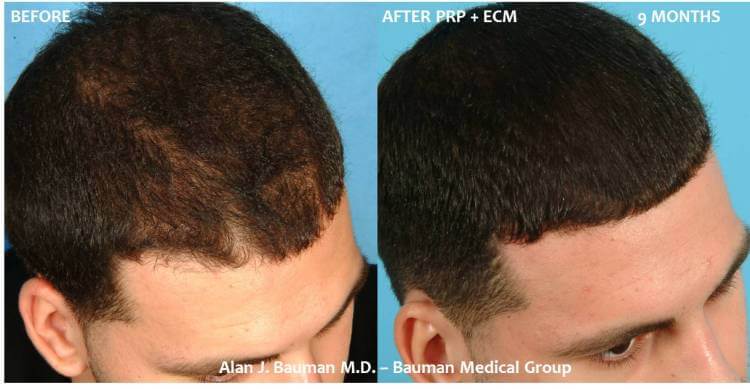 36 y/o Male PRP w/ECM Hair Regrowth Results