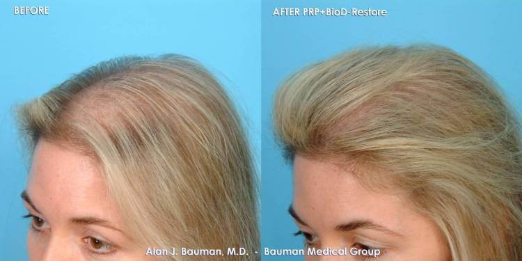 38 y/o Female PRP Hair Regrowth Treatment Results