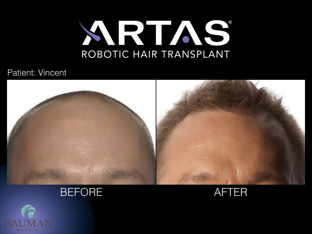 ARTAS robotic FUE hair transplant Boca Raton, Florida