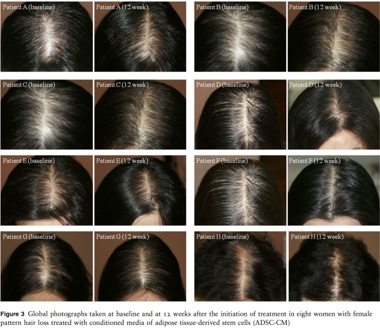 New Study: Use of AAPE Adipose-Derived Stem Cell Conditioned Media ADSC-CM in Female Pattern Hair Loss