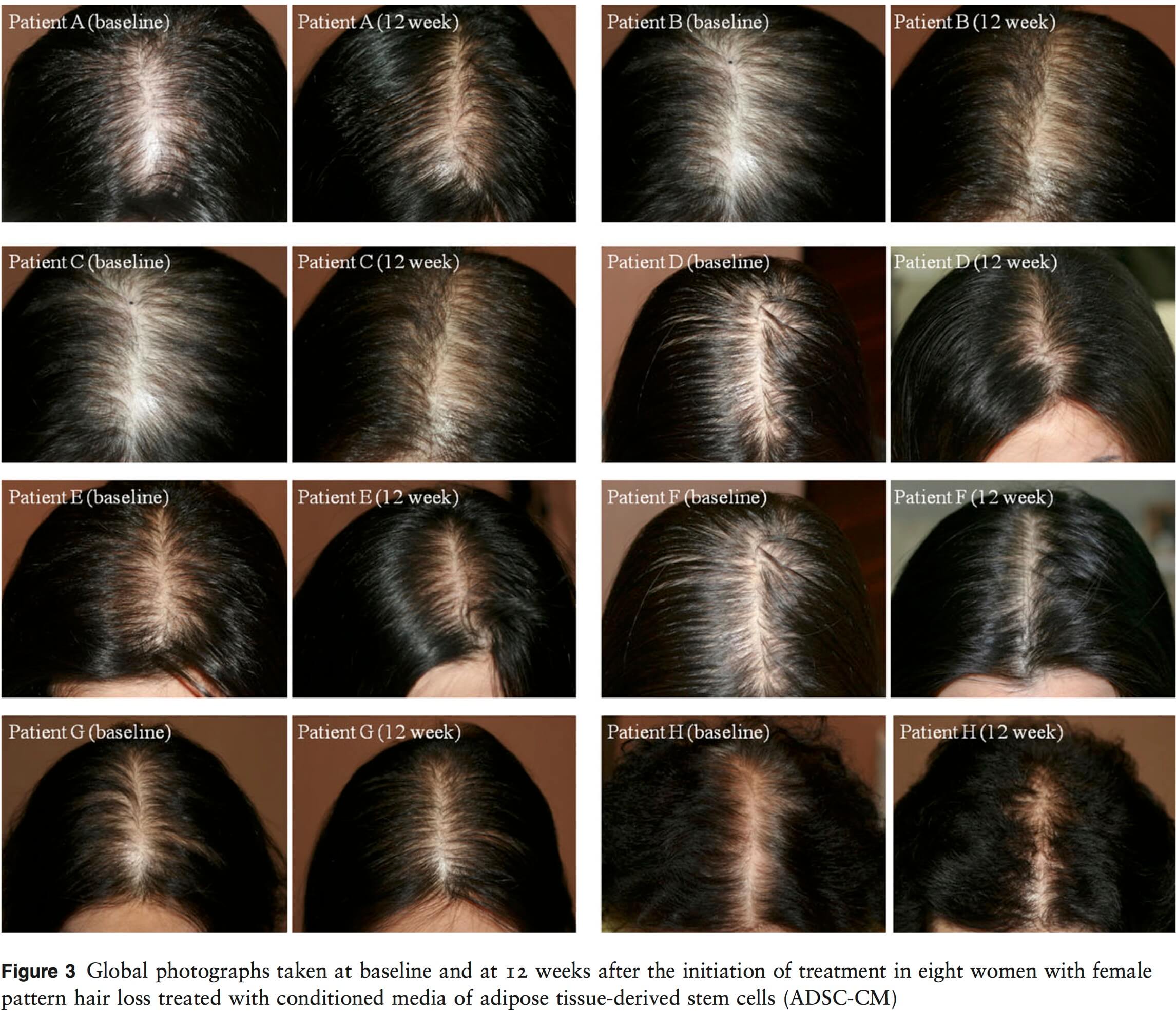 FEMALE PATTERN HAIRLOSS  My Hair Doctor  Prescription Haircare