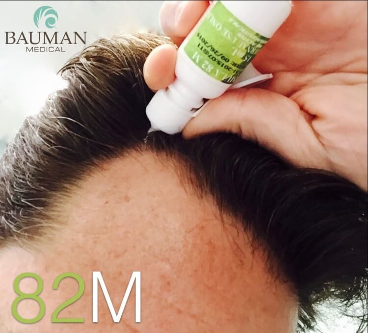 Formula 82M Compounded Minoxidil: Overview and How To Apply