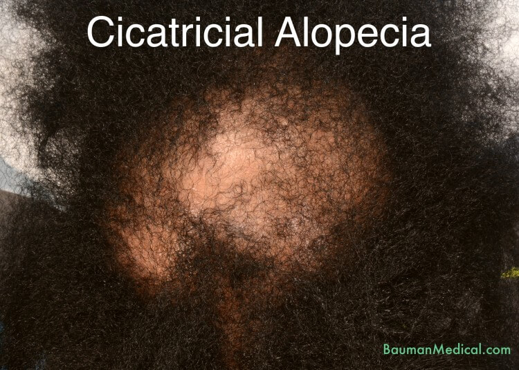 Cicatricial Alopecia