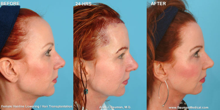 What is non-surgical hairline advancement?