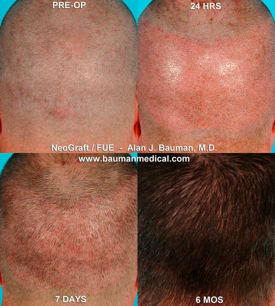 Dr Alan Bauman_Transplant_8 Fue No Linear Scar Fue Hair Transplant Donor Area Wound Healing