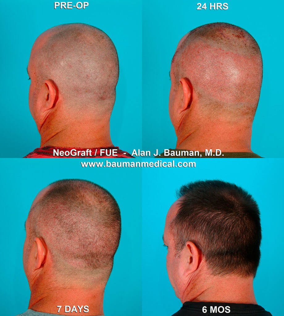 Fue Hair Transplant Donor Area Wound Healing