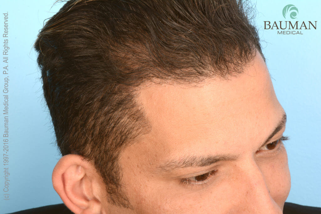 Natural Artistic Hairline - Patient Martino Cartier 1-Year After Dralanbauman Hair Transplant. See Natural Hairline Results.