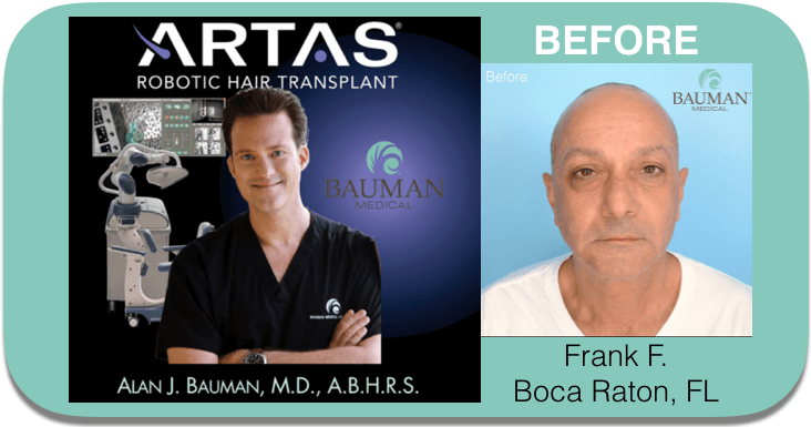 You’re invited to watch Dr. Alan J. Bauman at work with ARTAS to recreate and restore Frank’s youthful head of hair!