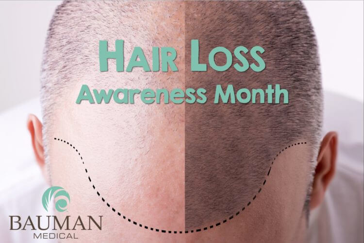 Press Release: National Hair Loss Awareness Month: 10 Best Treatments for Men and Women