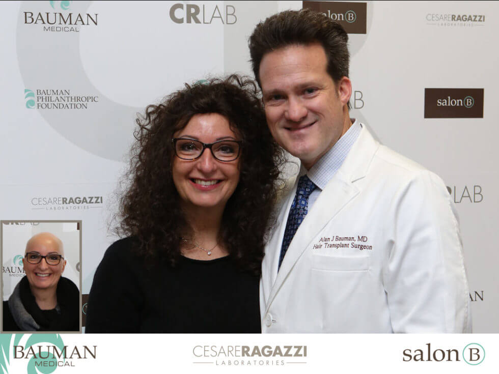 Dr. Bauman &Amp; Claudia, Alopecia Areata Totalis Patient Before And After Photo Of Crlab Cnc Hair &Amp; Scalp Prosthesis