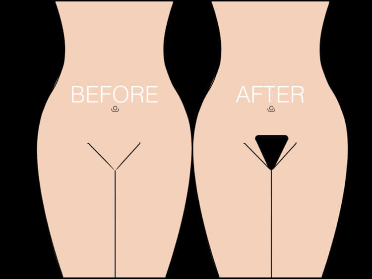 What is a Pubic Hair Transplant?