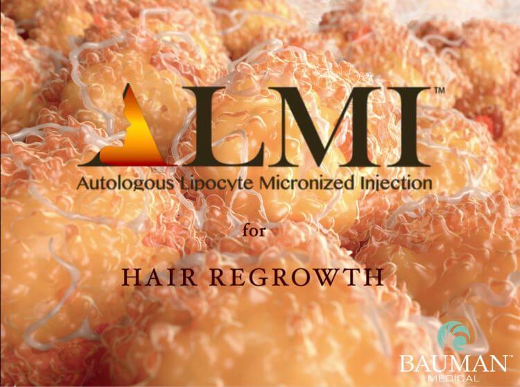 Nanofat – ALMI Autologous Lipocyte Micronized Injection for Hair Regrowth