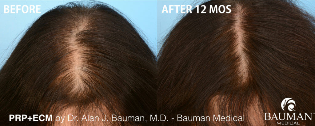 Prp Female Before-After-Dralanbauman.001