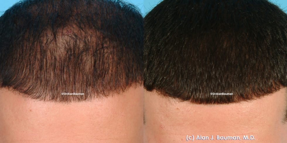 Vampire-Prp Treatment For Hair Loss - -