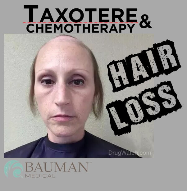 Taxotere Hair Loss and Baldness