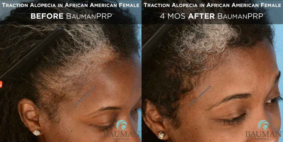 Traction Alopecia In African American Baumanprp - -