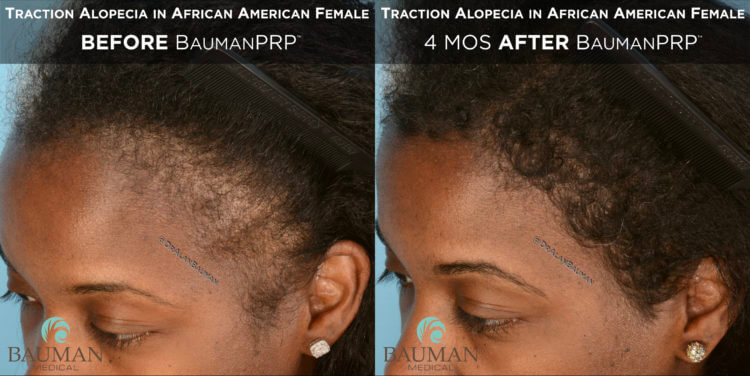 Traction Alopecia in African American BaumanPRP