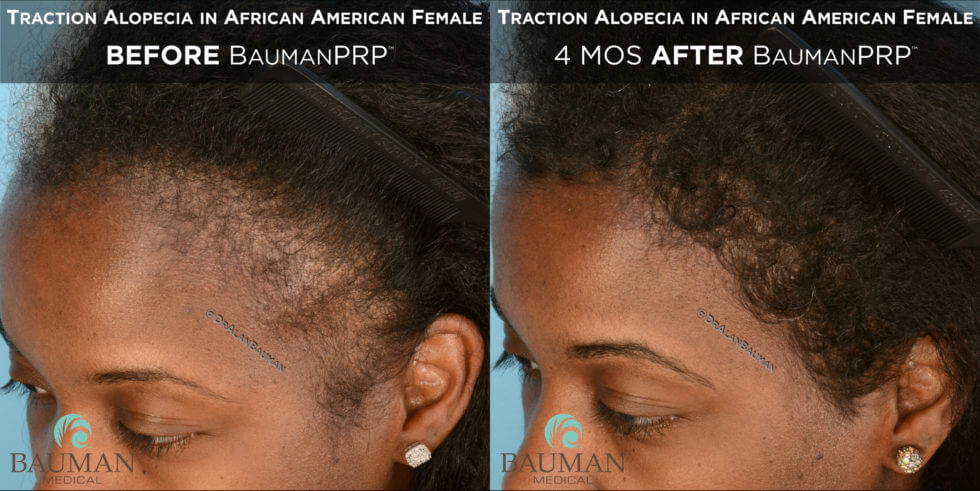 Africanamerican Traction Alopecia Temple Hairline Baumanprp Before After Results-02