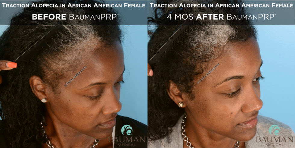 Traction Alopecia In African American Baumanprp - -