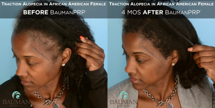 Traction Alopecia Before After PRP Platelet Rich Plasma in African American