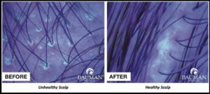 Unhealthy Scalp Sebum Scalp Makeover Bauman Before After