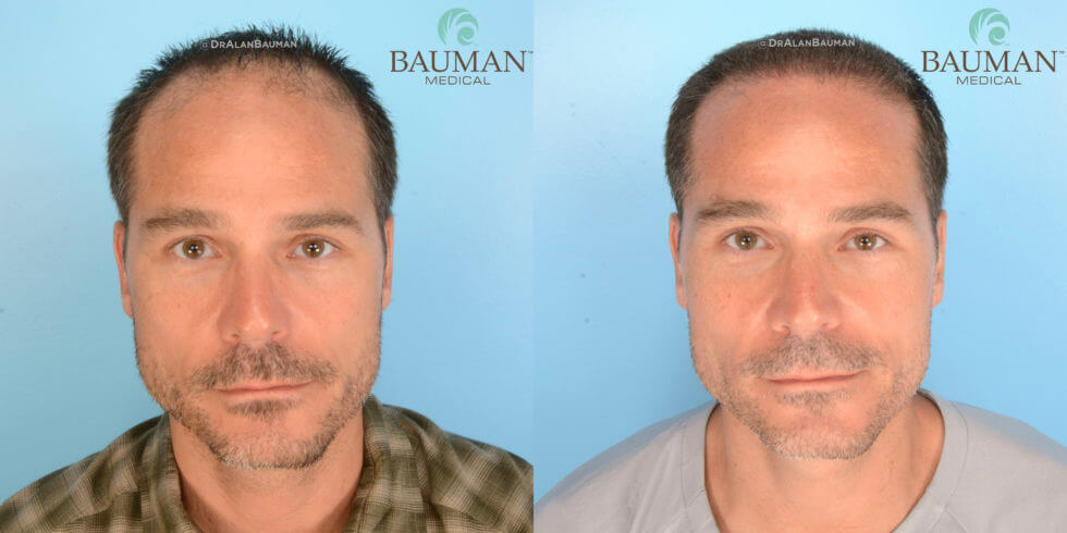 Dr. Alan Bauman Smartgraft Fue Patient Brian Hair Transplant Results After 12 Months. Front Photo.