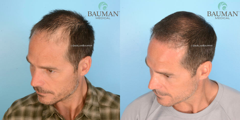 Dr. Alan Bauman Smartgraft Fue Patient Brian Hair Transplant Results After 12 Months. Side Photo.