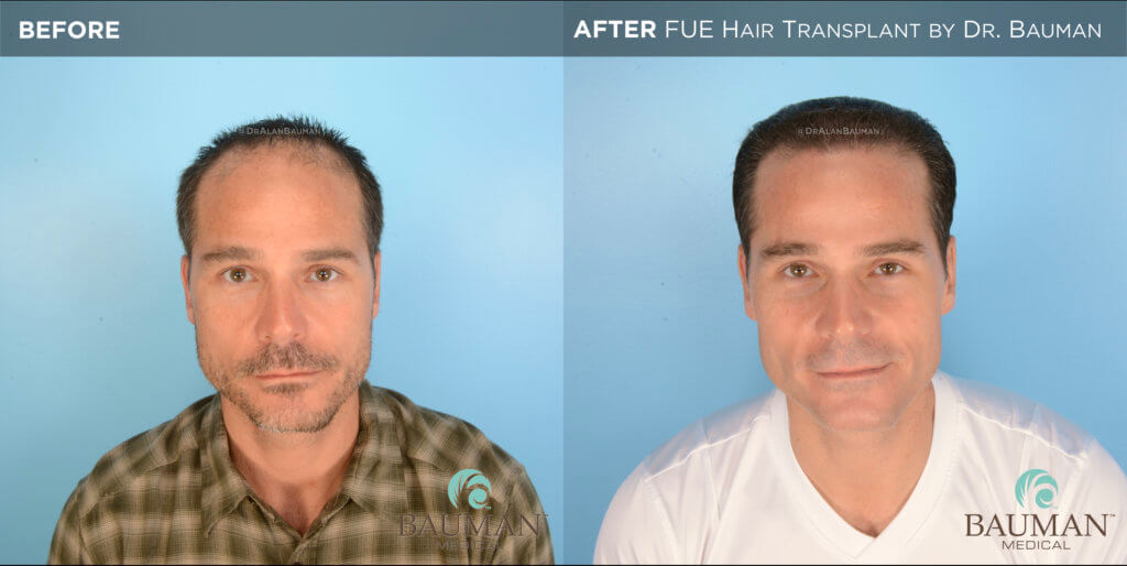 Fue Before After 12Mos - Brian - Dr Alan Bauman.001