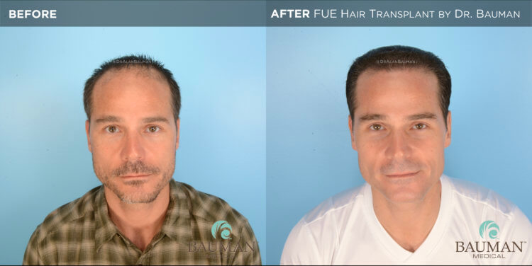 SmartGraft FUE Hair Transplant Results from Dr. Alan Bauman