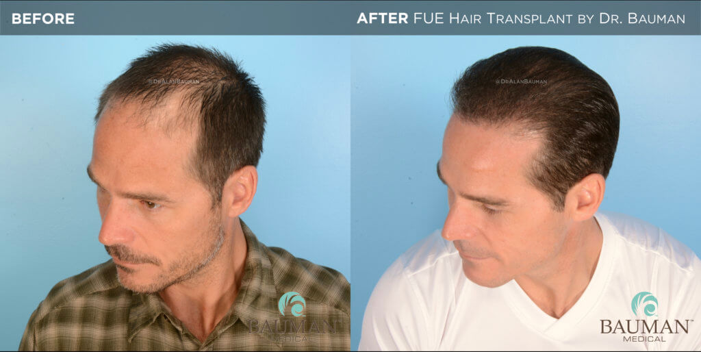 Fue Before After 12Mos - Brian - Dr Alan Bauman.002