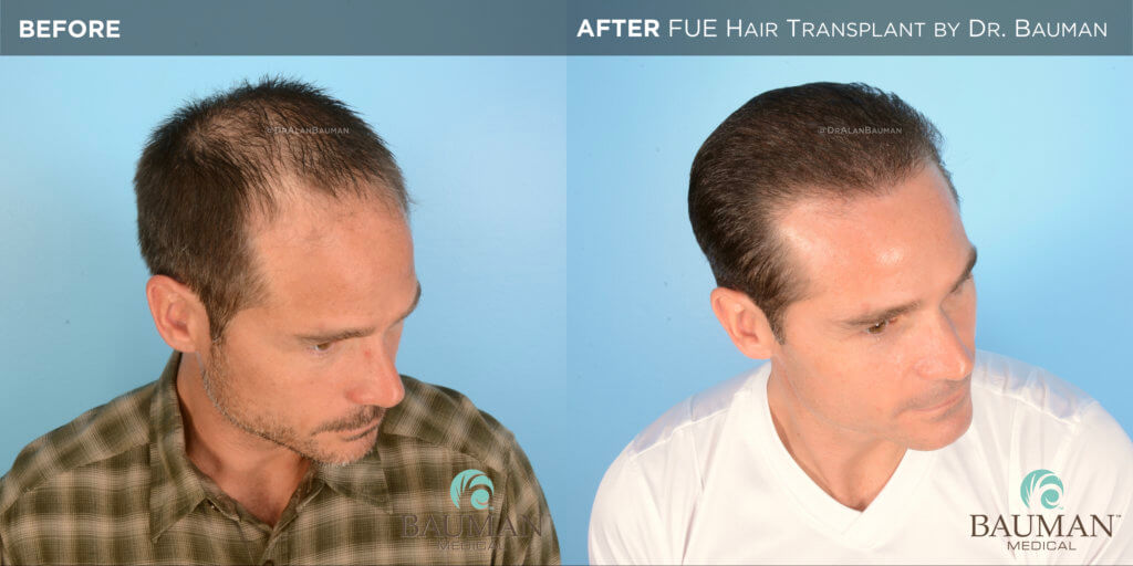 Fue Before After 12Mos - Brian - Dr Alan Bauman.004