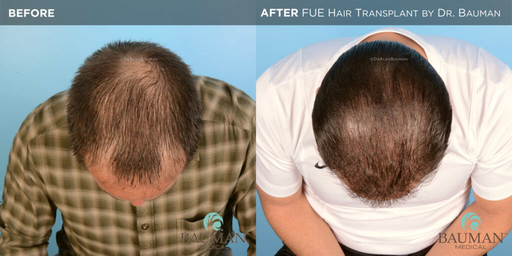 Fue Before After 12Mos - Brian - Dr Alan Bauman.005