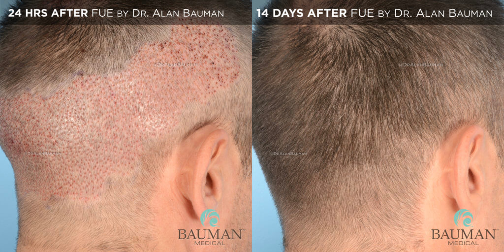 Fue Donor Area 24Hrs + 14Days - Brian - Dr Alan Bauman.006