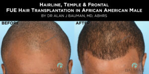 Before-After: African Afro Caribbean Ethnic Fue Hair Transplant Using Smartgraft - -