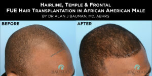 Before-After: African Afro Caribbean Ethnic Fue Hair Transplant Using Smartgraft - -