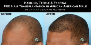 Before-After: African Afro Caribbean Ethnic Fue Hair Transplant Using Smartgraft - -