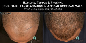 Before-After: African Afro Caribbean Ethnic Fue Hair Transplant Using Smartgraft - -