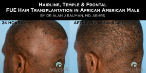 Before-After: African Afro Caribbean Ethnic Fue Hair Transplant Using Smartgraft - -