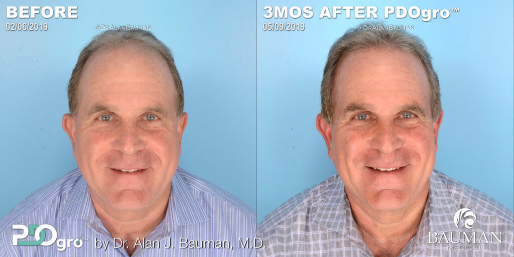 Before And 3 Months After Pdogro Procedure By Dr. Alan Bauman For Male Pattern Hair Loss.