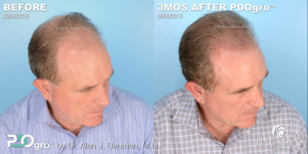 Before And 3 Months After Pdogro Procedure By Dr. Alan Bauman For Male Pattern Hair Loss.