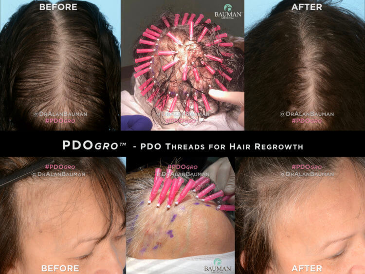 PRESS RELEASE: DR. ALAN J. BAUMAN FIRST IN USA TO USE PDOgro™ PDO THREAD PROCEDURE FOR HAIR REGROWTH