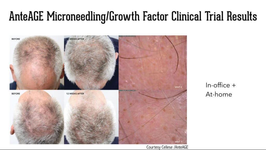 Anteage Microneedling Hair Regrowth Stem Cell Derived Growth Factor Cytokine