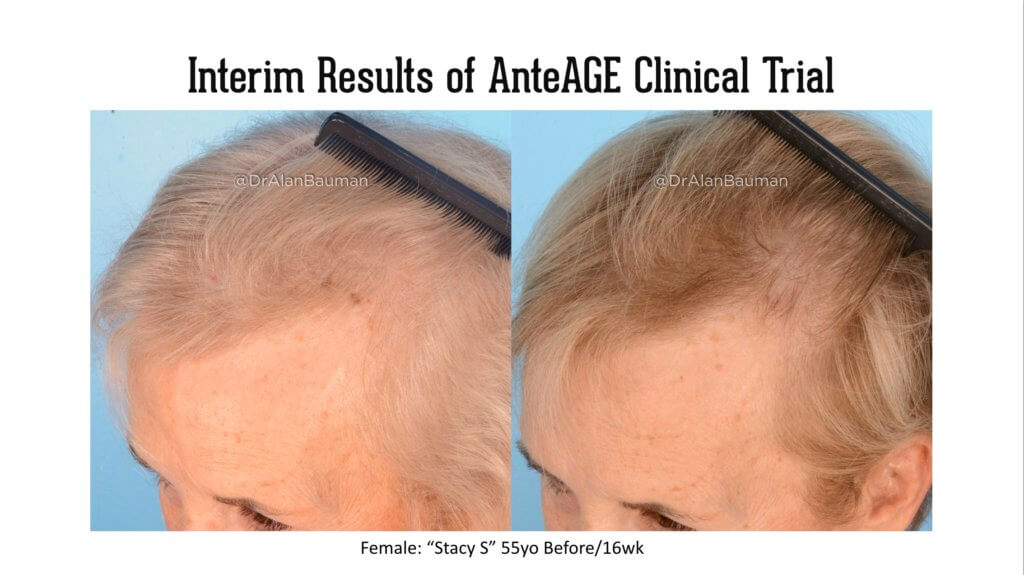 Clinical Trial Anteage Growth Factor Cytokine Treatment For Hair Regrowth