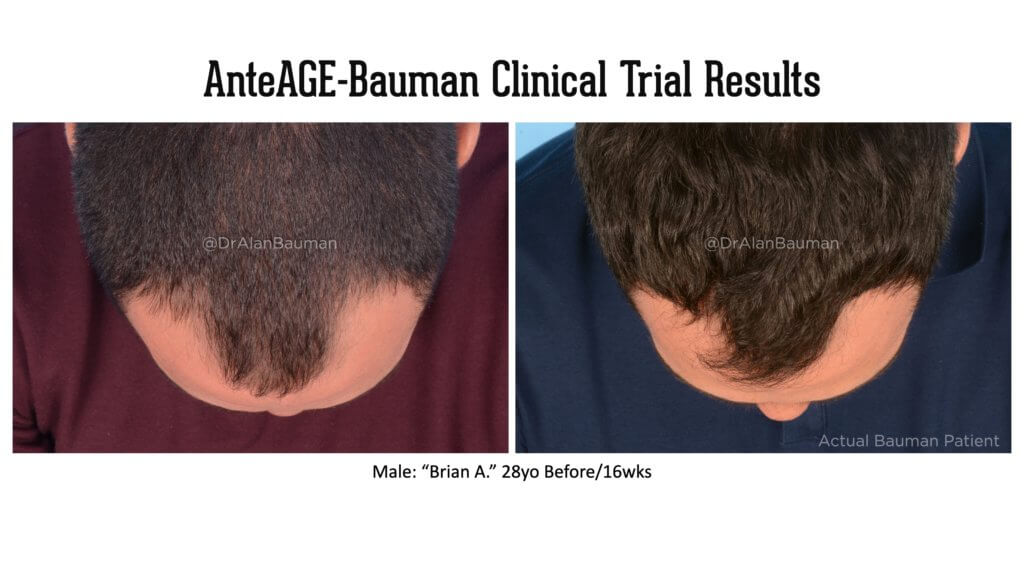 Bauman-Anteage Clinical Trial Results_28M-Top