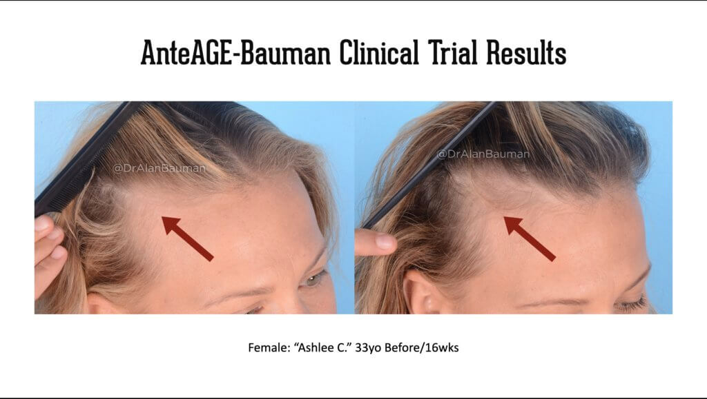 Bauman-Anteage Clinical Trial Virtual Prp Results 33F-Temples