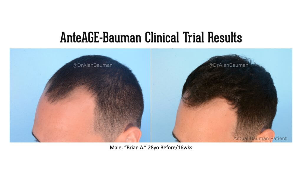 Bauman-Anteage Clinical Trial Virtualprp Results_28M-Temples