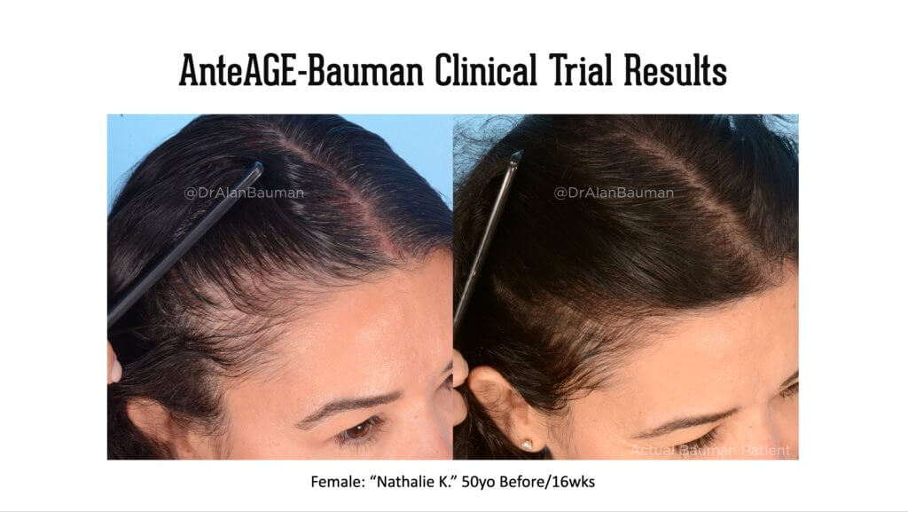 Bauman-Anteage Clinical Trial Results Virtualprp 50F-Temples